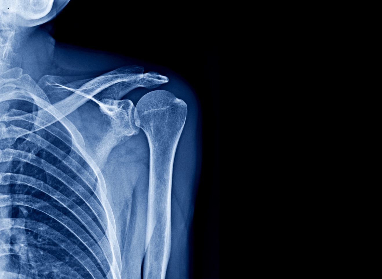 sklett armbåge röntgen