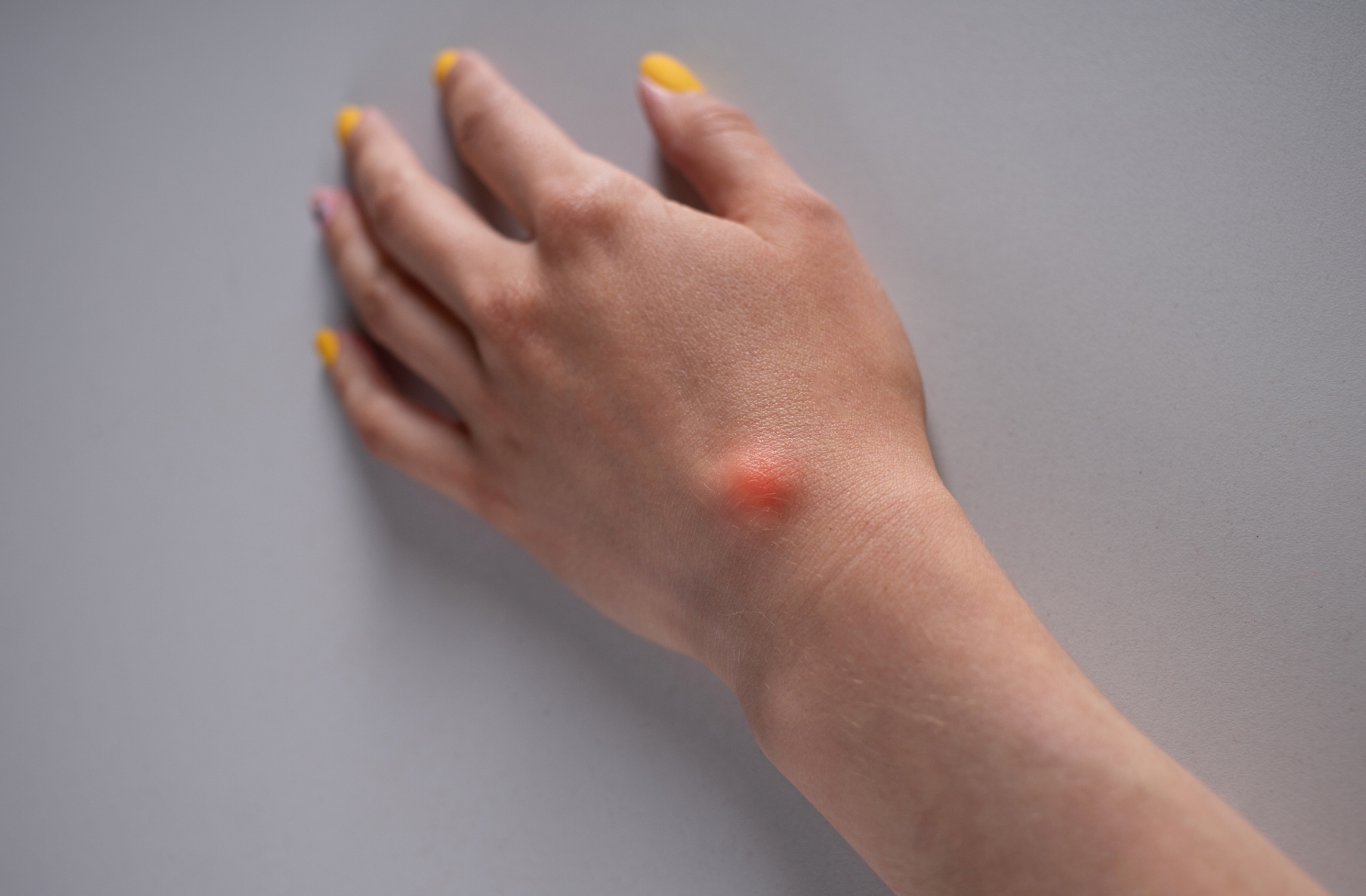 bild på hand med cysta