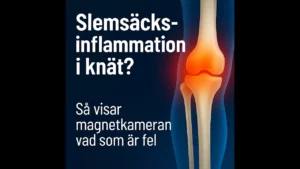 slemsäcksinflammation i knät thumbnail