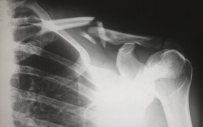 Allt om axelskador – symptom, diagnos med MR och behandling
