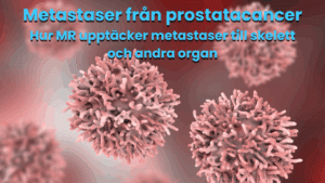 metastaser prostatacancer