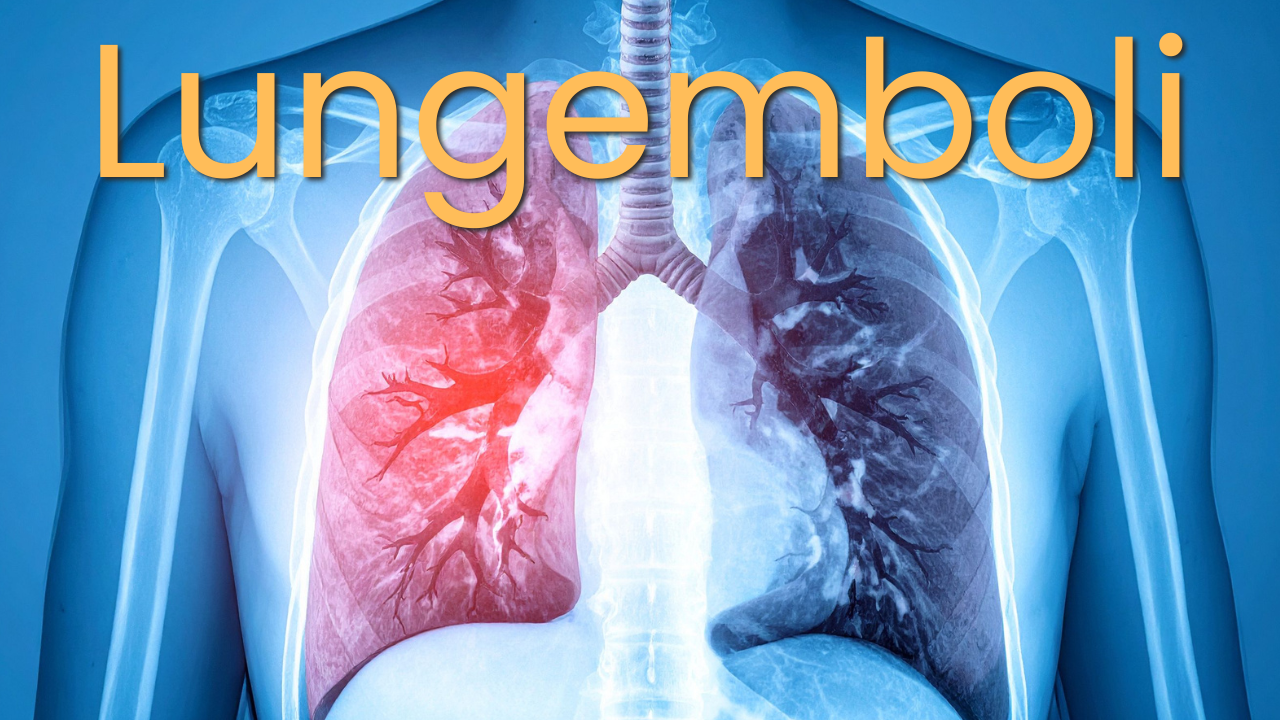 lungemboli thumbnail