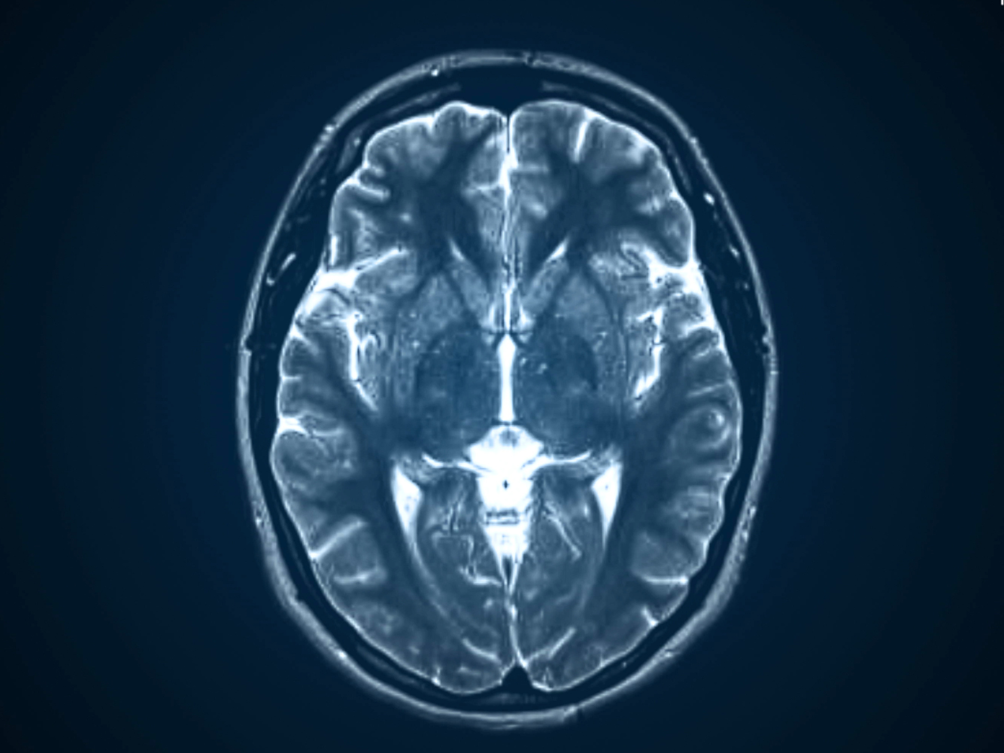 MR-bild av hjärnan ovanifrån